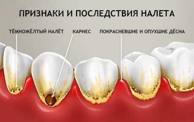 как избавиться от зубного налета