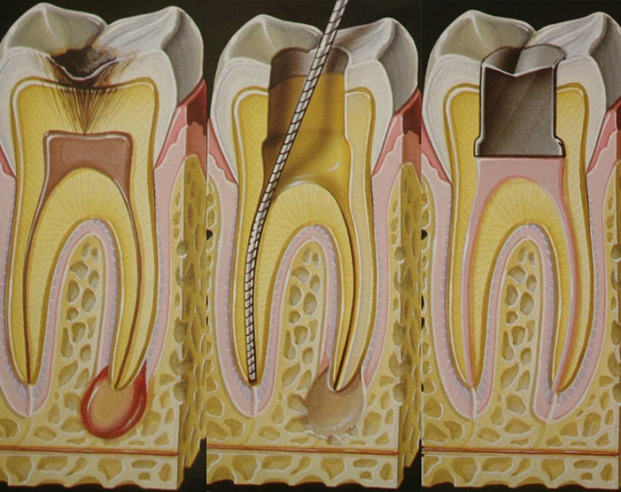 Лечение зуба эндодонтическое